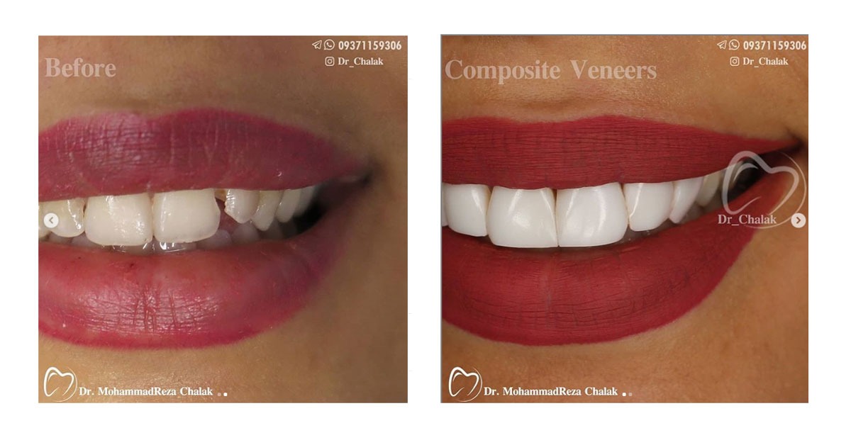 کامپوزیت ونیر قبل و بعد