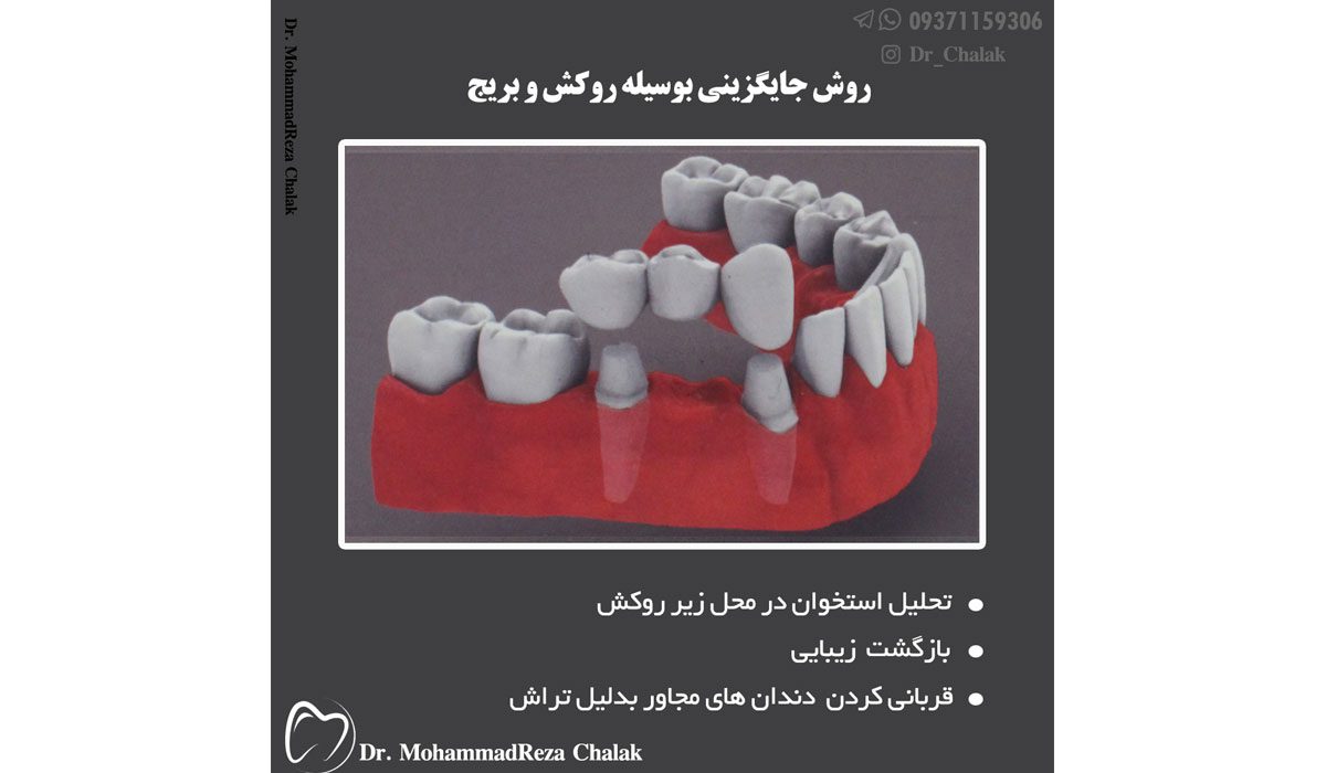 مقایسه ایمپلنت دندان و بریج دندان