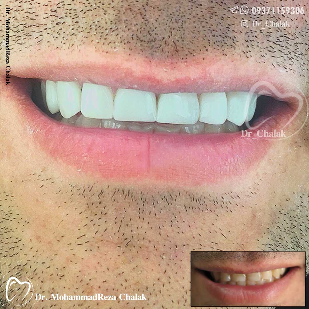 کامپوزیت دندان