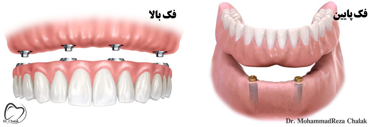 اودرنچر فک بالا و پایین
