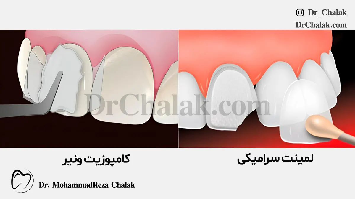 عکس لمینت و کامپوزیت دندان