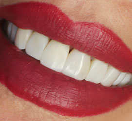 کامپوزیت دندان های فک بالا