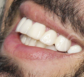 لمینیت دندان