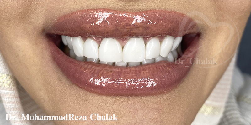 کامپوزیت ونیر دندان های فک بالا و پایین رنگ سفید طبیعی