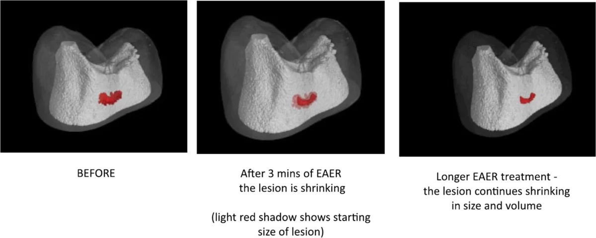 EAER (Electrically Accelerated Enhanced Remineralization) 