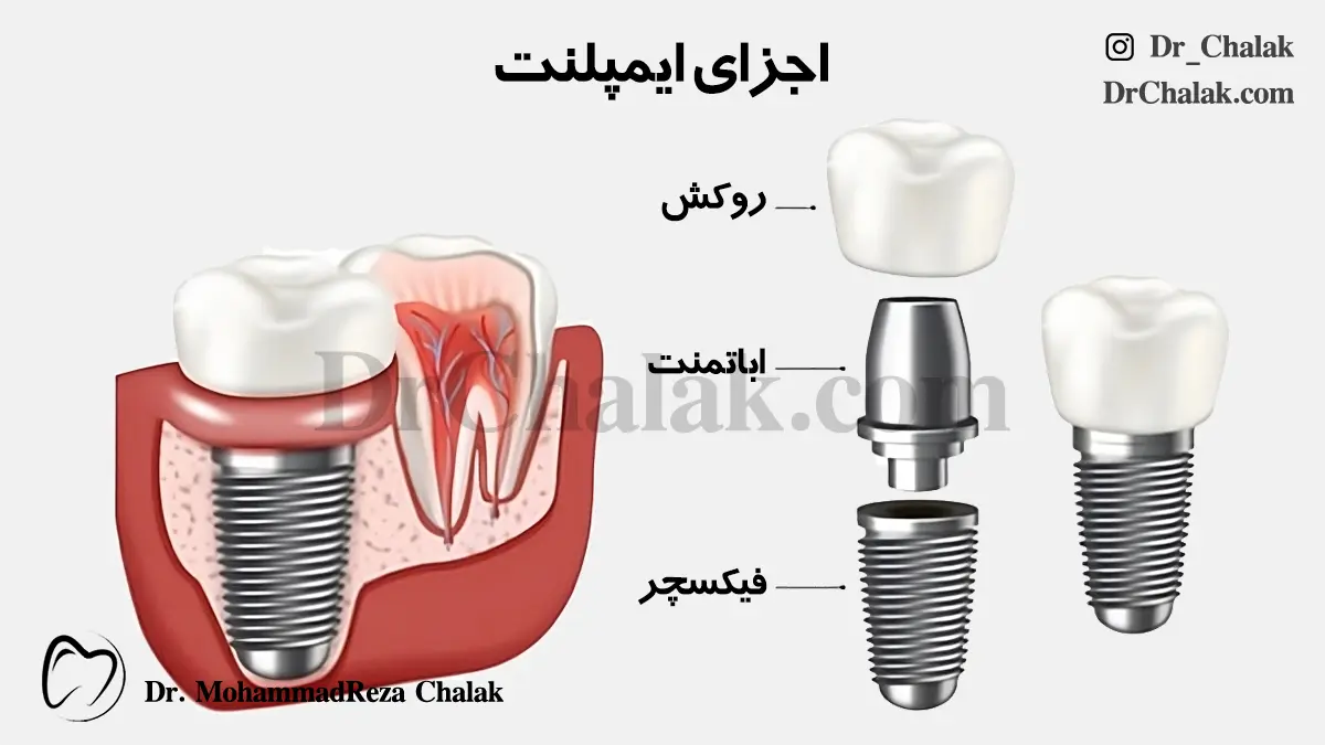 اجزای ایمپلنت روکش اباتمنت فیکسچر