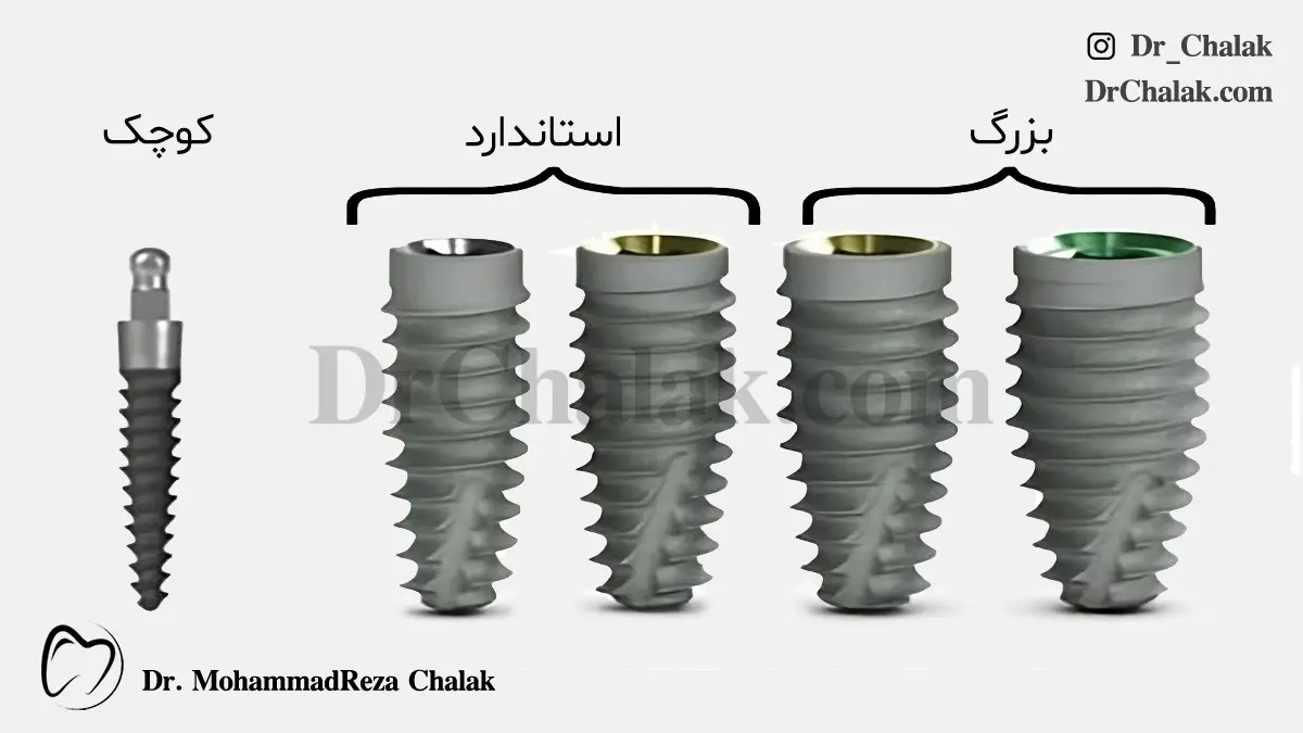 انواع ایمپلنت براساس سایز ایمپلنت های بزرگ کوچک و مینی ایمپلنت