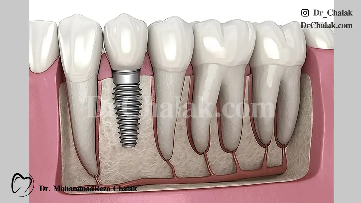 ایمپلنت ناموفق دندان فیلد ایمپلنت شکستن ایمپلنت