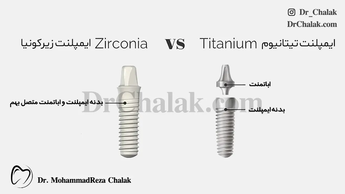 تفاوت ایمپلنت تیتانیوم و ایمپلنت زیرکونیا