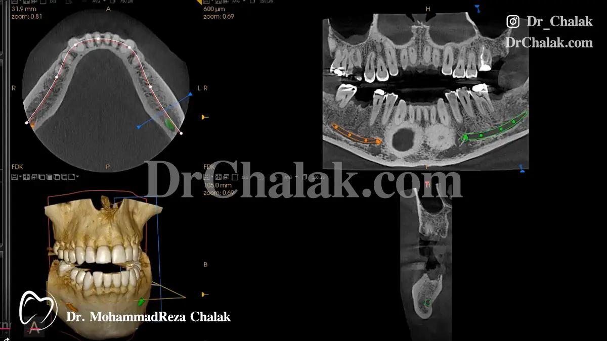 عکس سه بعدی ایمپلنت دیجیتال