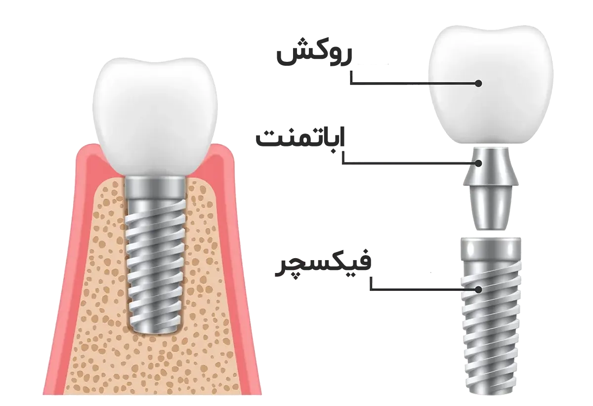 اجزای ایمپلنت دندان