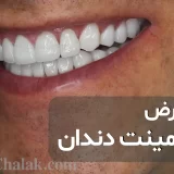 عوارض لمینت دندان و دلایل نارضایتی لمینت