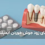 راههای زود جوش خوردن ایمپلنت | افزایش سرعت ترمیم ایمپلنت دندان 🦷✨