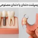 ایمپلنت دندان یا دندان مصنوعی؟ راهنمای کامل برای تصمیم‌گیری هوشمندانه